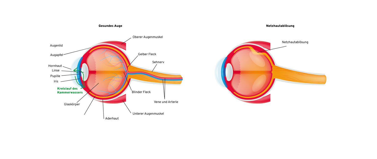 netzhautabl-sung-ablatio-retinae-amotio-retinae-augenzentrum